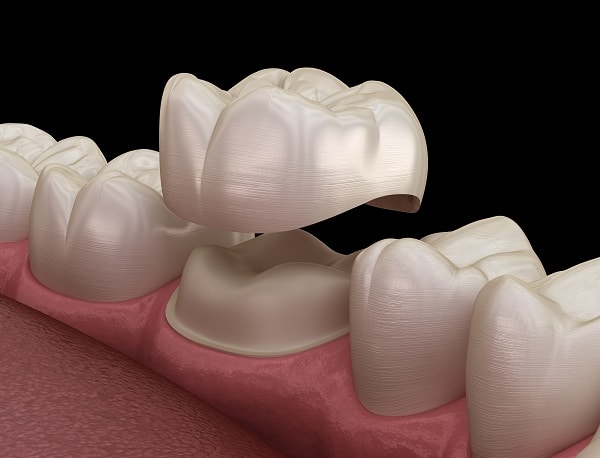 img-crown-lengthening in tempe dentist