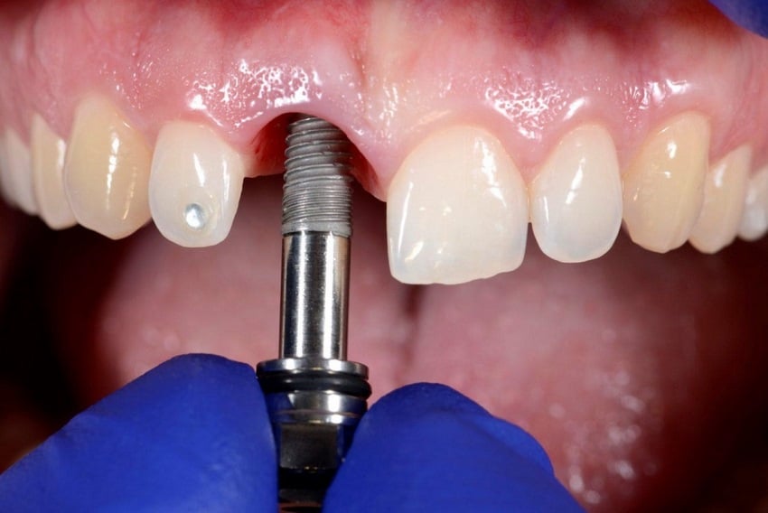 dental implants in tempe dentist