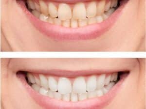 Teeth whitening Tempe at Okun dentistry